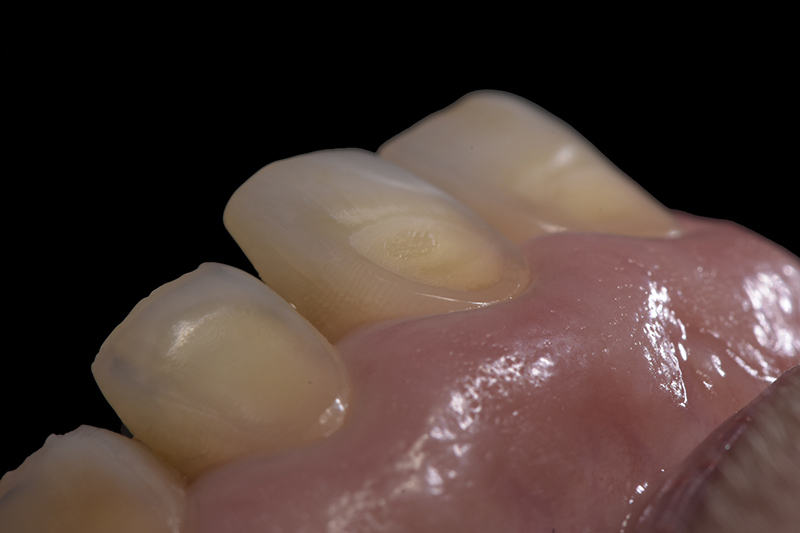 Gros plan sur les lésions 