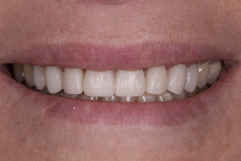 sourire post opératoire