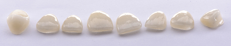 Restaurations en disilicate de lithium 