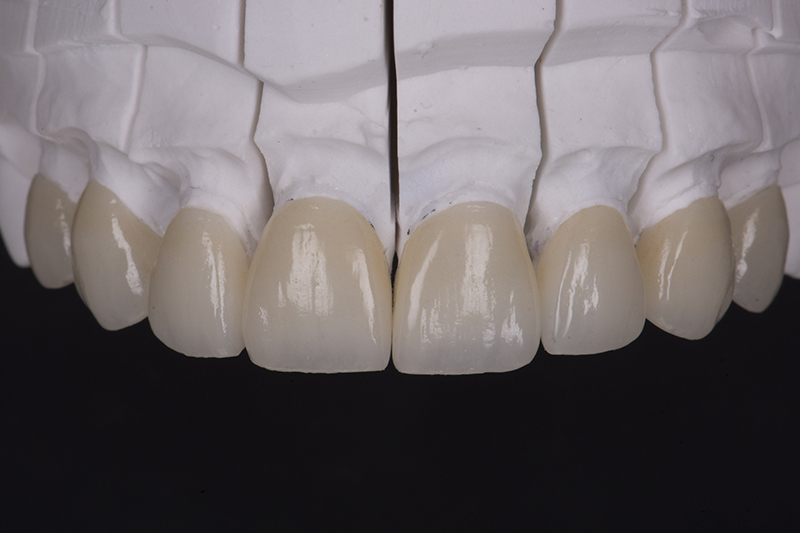 restaurations adhésives en céramiques