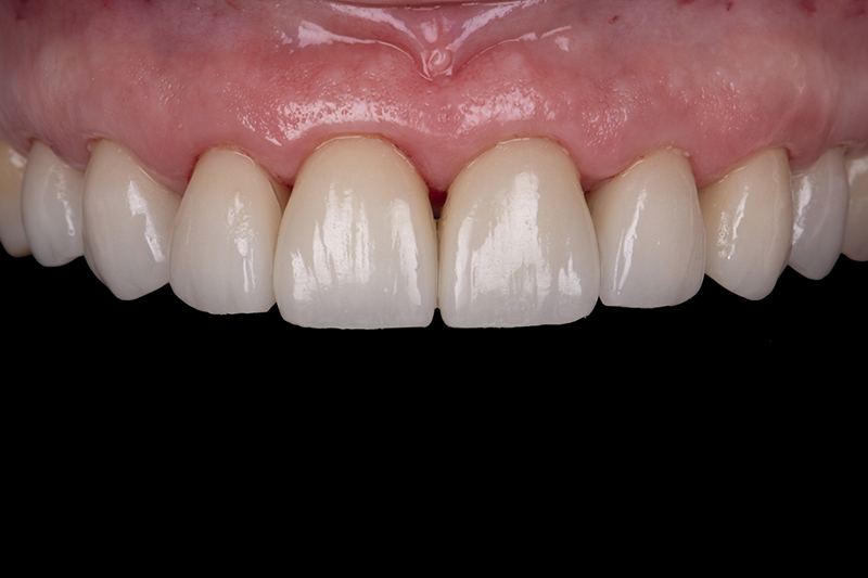 résultat post opératoire immédiat