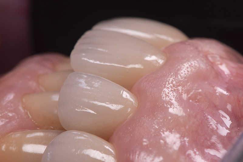 Résultat post opératoire à 1 mois-2