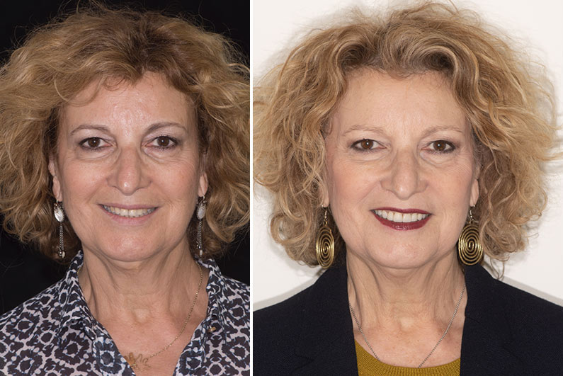 Avant / Après traitement