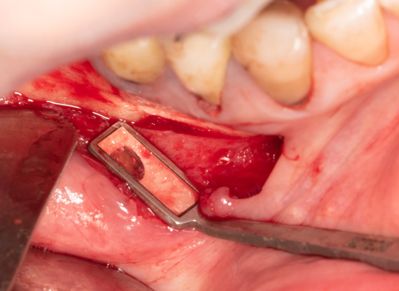 Radiographie post-opératoire