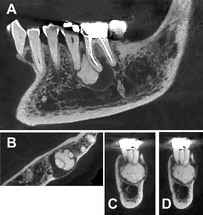 Figure-1a-Mme-P_3eme-cas