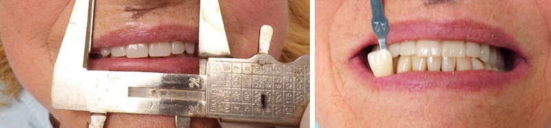 Essayage esthétique