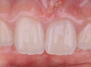 Vue-initiale - L'apexification