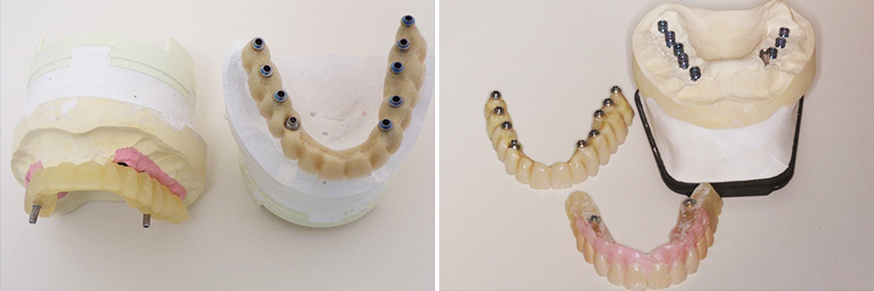 Montage esthétique antérieur