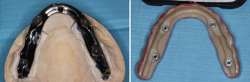 Vue occlusale et intrados