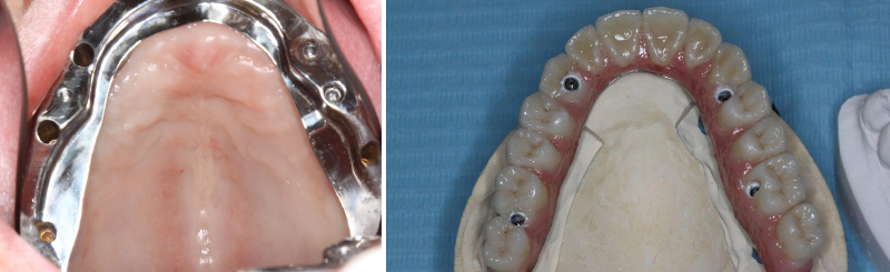 Vues occlusales en bouche et sur modèle 