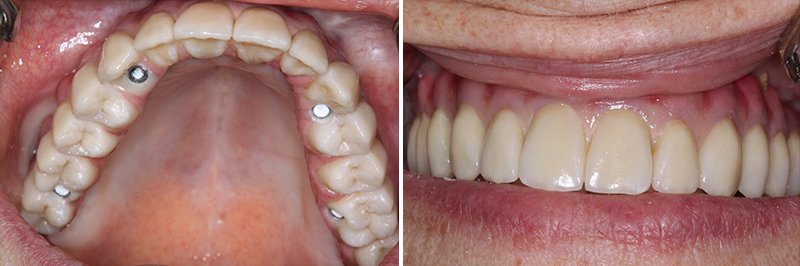 Vue occlusale et buccale