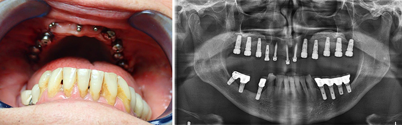 implants temporaires