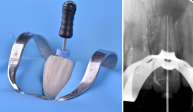 Détermination de la longueur de travail - L'apexification