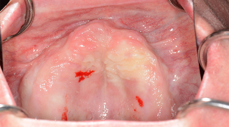 Fig-05-vue-occlusale