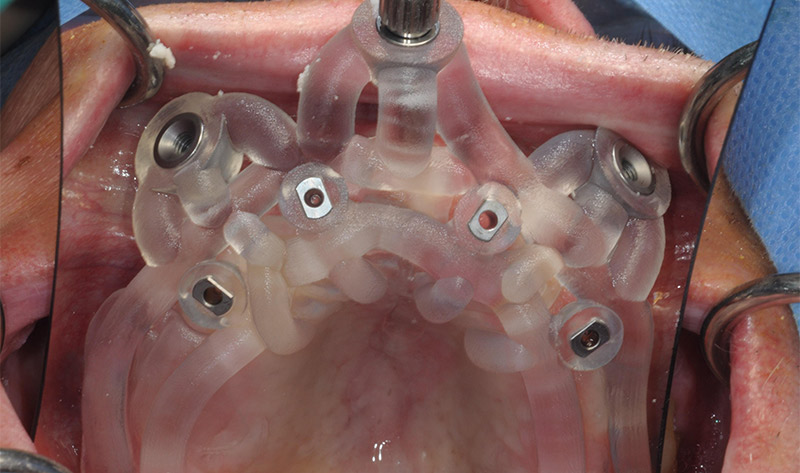 Fig-06-gouttière chirurgicale en place