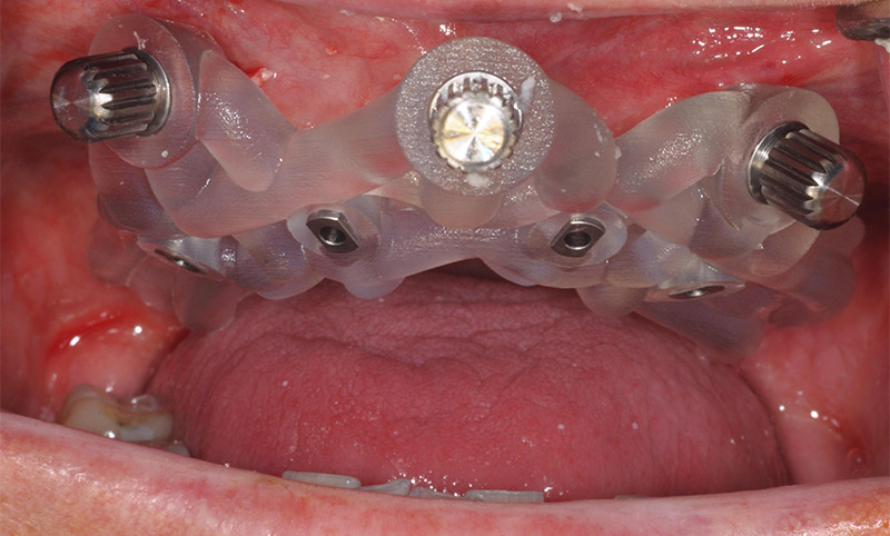 Fig-07-gouttière chirurgicale en place