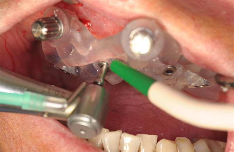 Fig-08-pointeur en Flapless