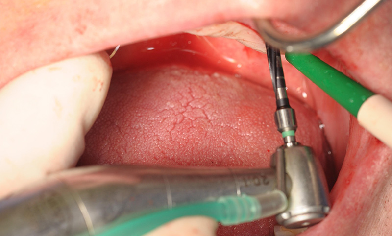 Fig-09-foret 2 mm en Flapless