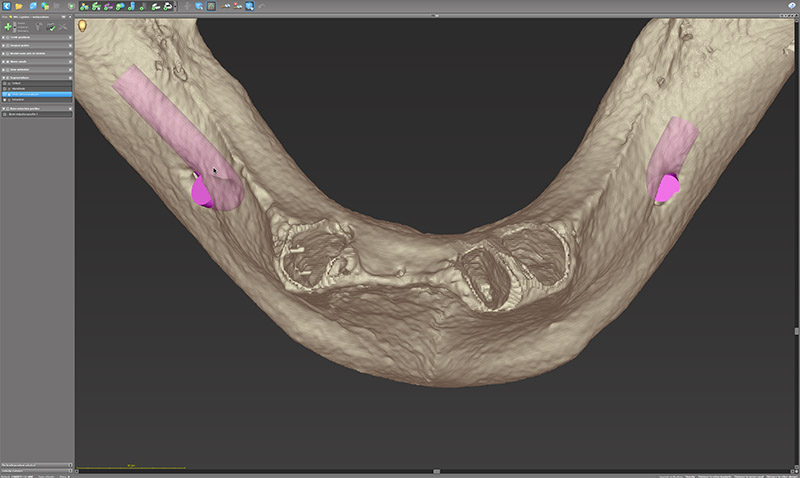 Mise en évidence des alvéoles