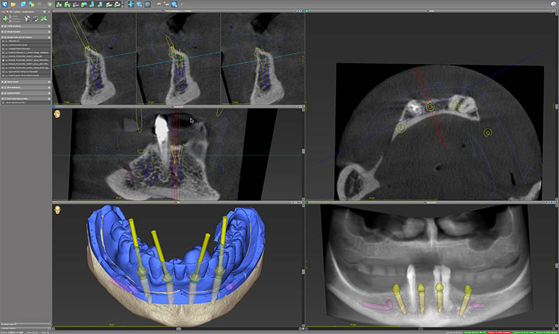 Essayage et validation de la prothèse