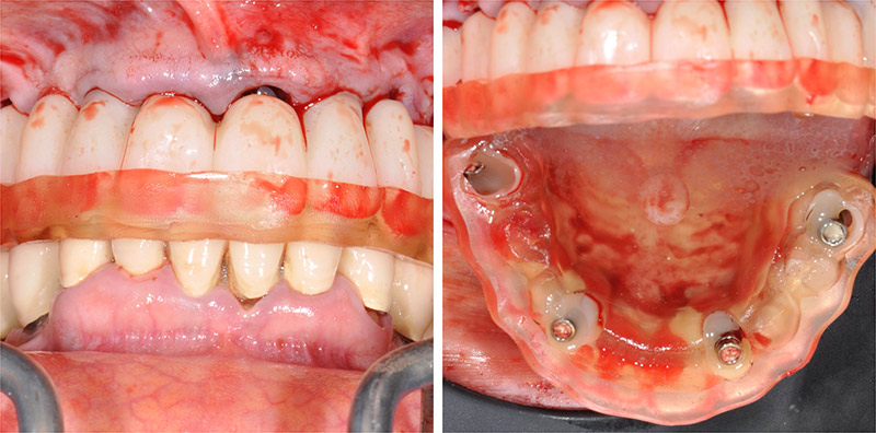 Gouttière de repositionnement