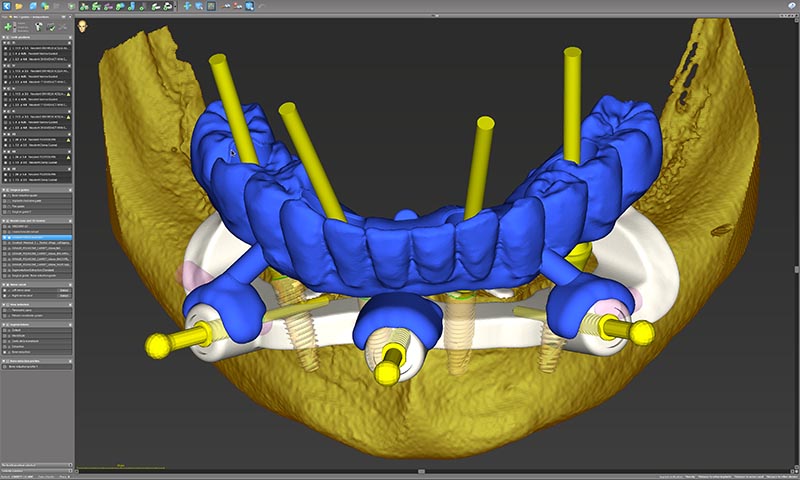 Restauration transitoire