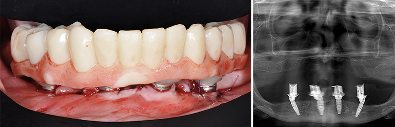 Finition premier cas