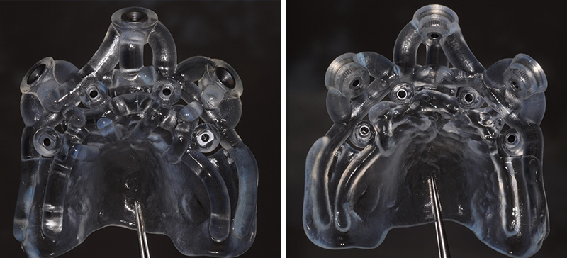 Fig-4-gouttière chirurgicale