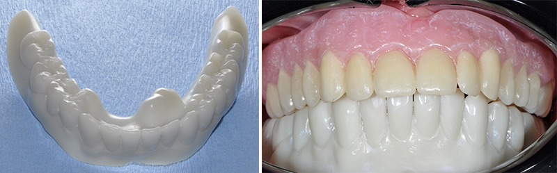La prothèse diagnostique imprimée et essayée