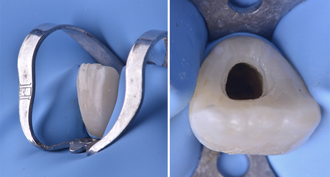 Isolation unitaire à l’aide d’un crampon incisif