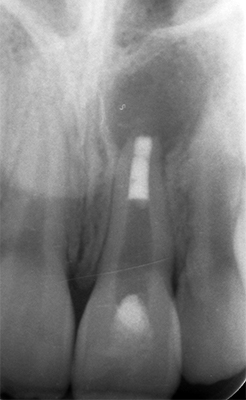 Radio bouchon apical - L'apexification