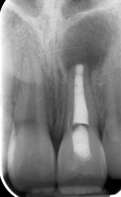 Radiographie post opératoire