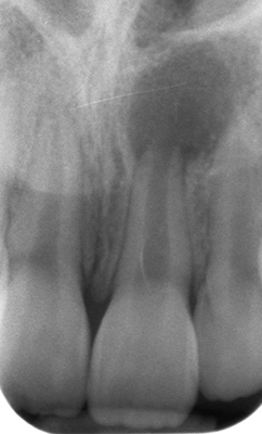 Radiographie rétro alvéolaire pré opératoire