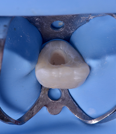 Remplissage du canal