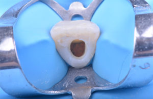 Vue clinique après obturation du canal