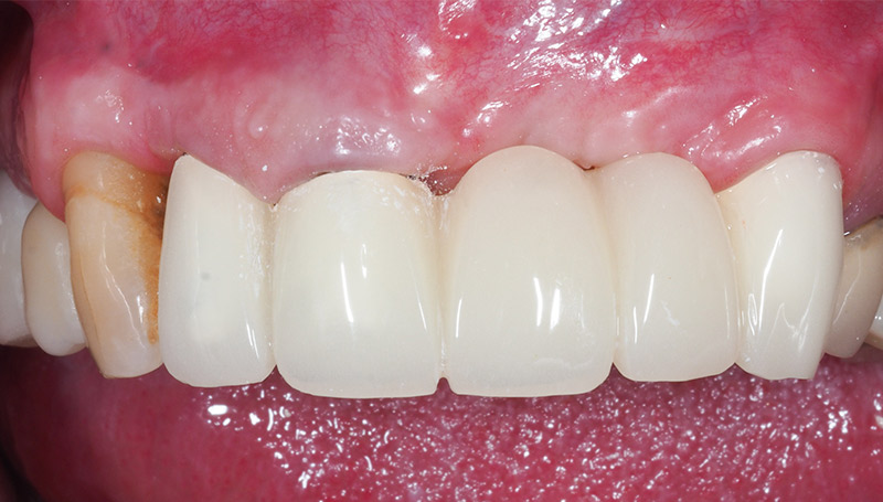 Bridge-provisoire-41