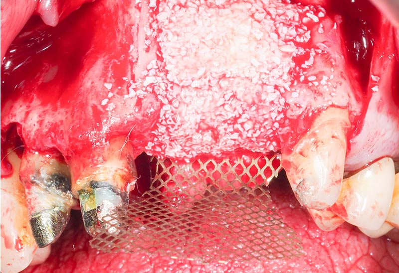 Comblement-deficit-osseux-16