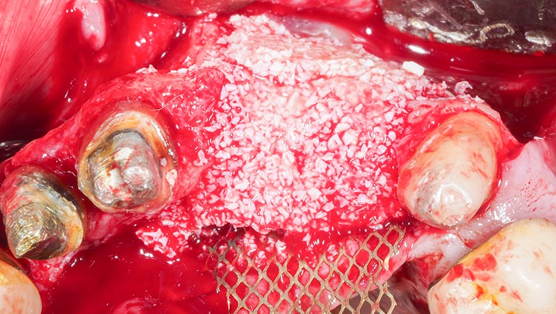 Comblement-deficit-osseux-17