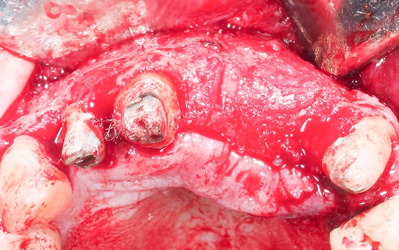 Contour-volume-vue-occlusale-37