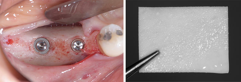 Implant + Membrane Mucoderm