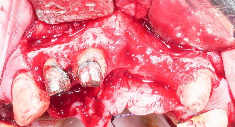 Lambeau-pleine-epaisseur-11