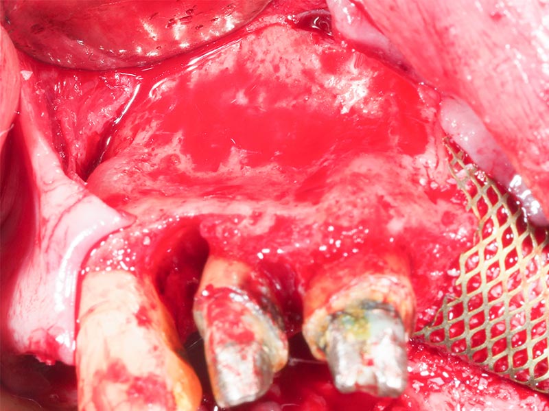 Lesion-infra-osseuse-19