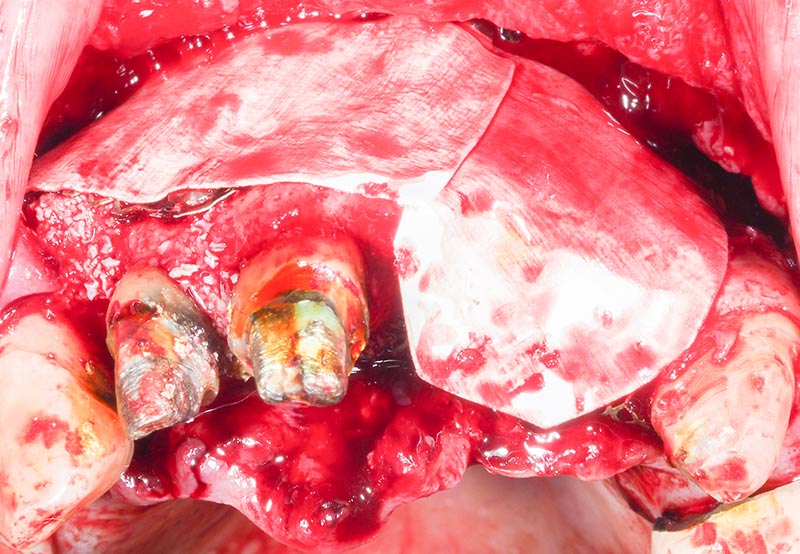 Membrane-resorbables-22