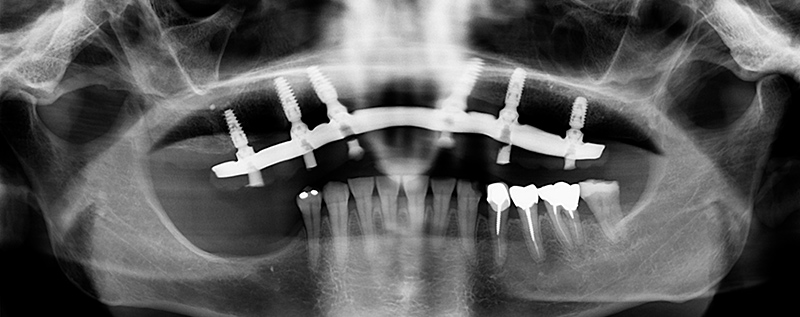 Radiographie-initiale-1