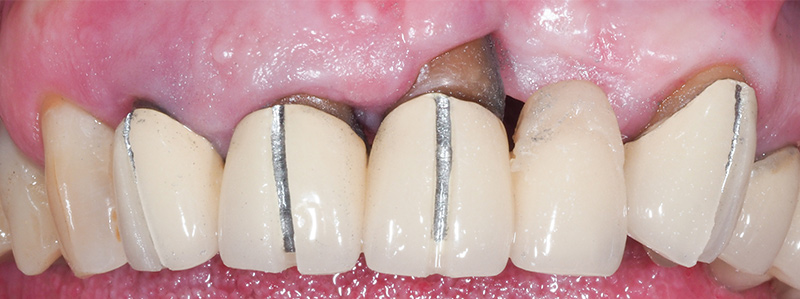 Restauration-prothetiques-7