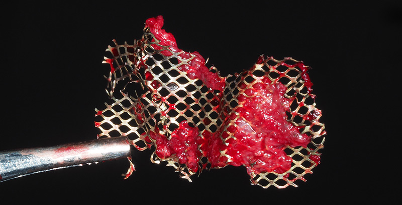 Retrait-Grille-titane-36