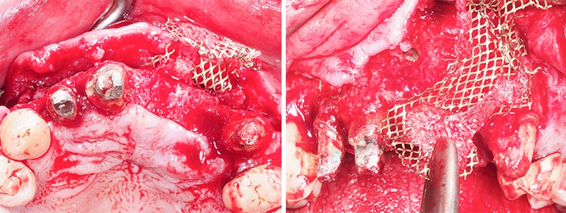 Retrait grille titane-34-35