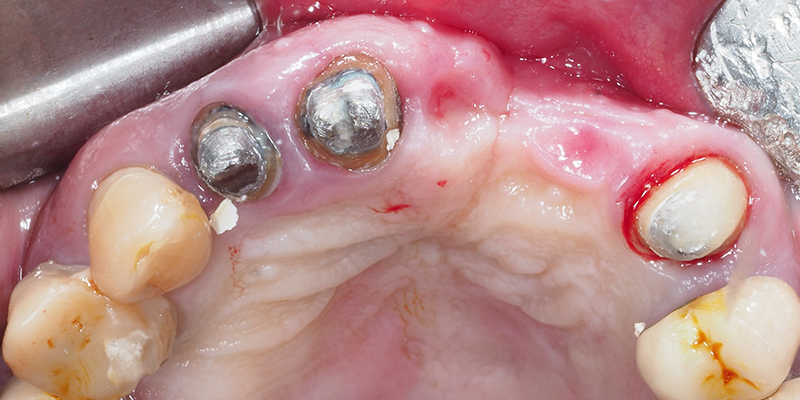 Vue-occlusale-pre-operatoire-10