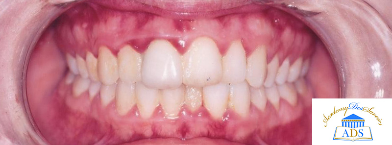 Figure-1-Inflammation gingivale