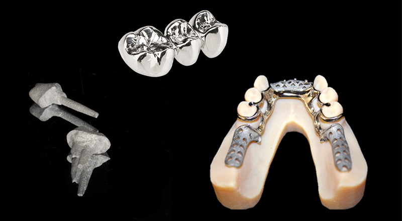 Inlays-couronnes-chassis-Imprimante-3D-Lanoiselée